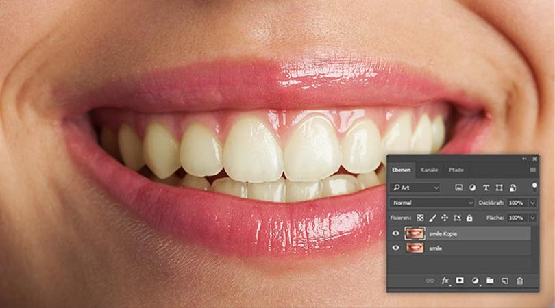 Ausgangsbild - verfärbte Zähne